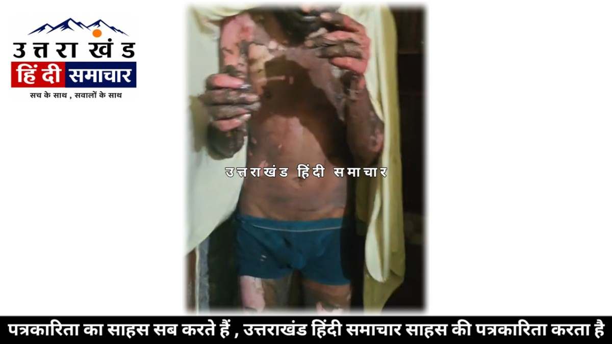 हड़कंप : तू मायके चली गई... मैंने डीजल डालकर आग लगा ली